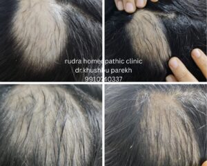 alopecia cured by homeopathic doctor khushbu parekh