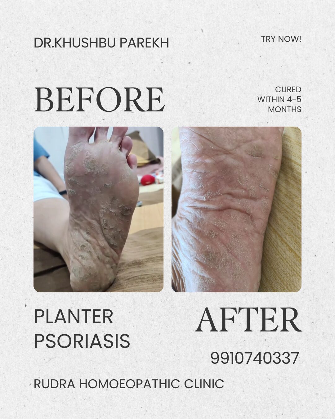 Gray Brown Simple Aesthetic Before After Instagram Post