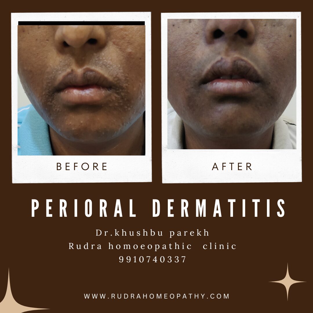 Perioral dermatitis