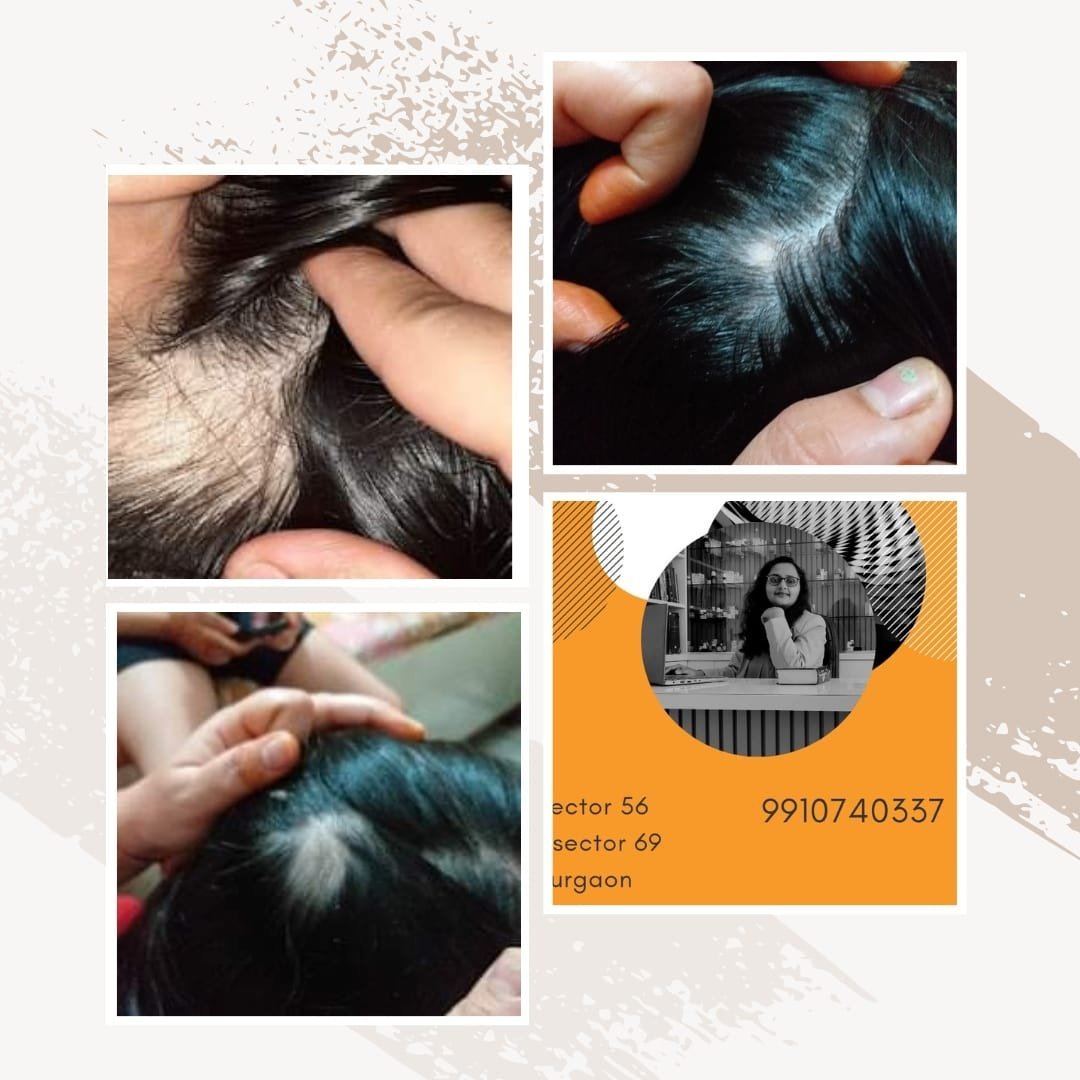 alopecia areata
