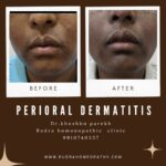 perioral derattitis